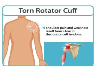 rotator-cuff-specialists-and-shoulder-injury-treatment-small-0