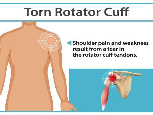 rotator-cuff-specialists-and-shoulder-injury-treatment