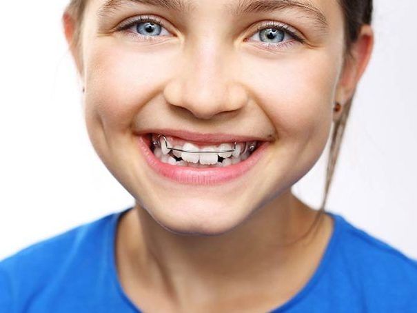 benefits-of-early-phase-1-orthodontics