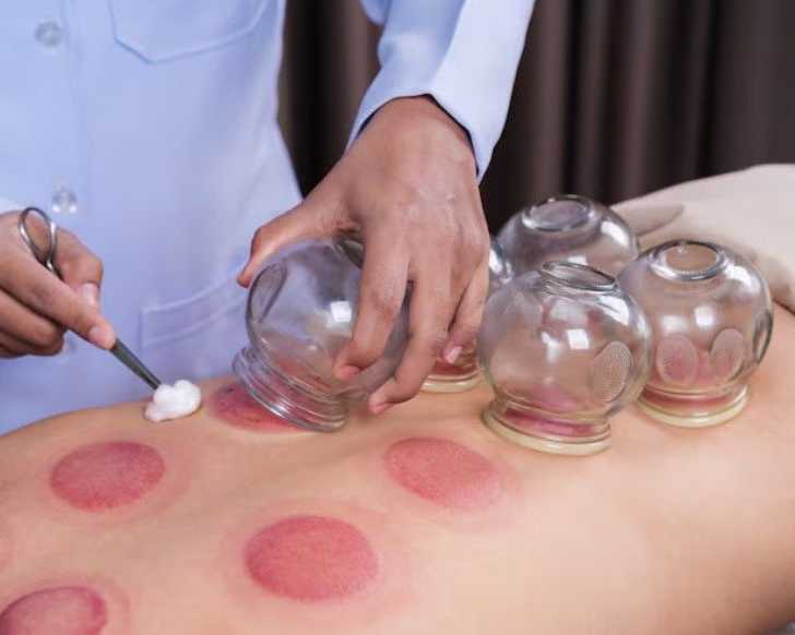 cupping-therapy-greenville-sc-for-natural-relief-wellness-care