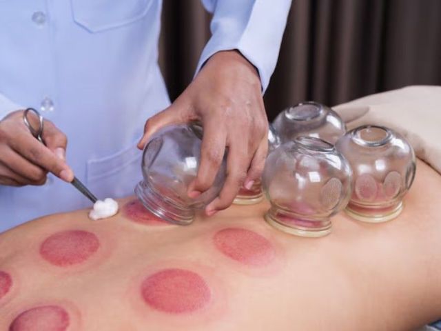 cupping-therapy-greenville-sc-for-natural-relief-wellness-care