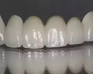 zirconia-dental-implants-metal-free-solution-for-a-natural-smile