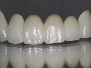 zirconia-dental-implants-metal-free-solution-for-a-natural-smile