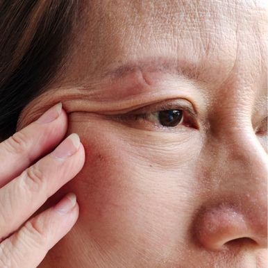 eyelid-surgery-in-los-angeles-big-1