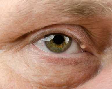 eyelid-surgery-in-los-angeles