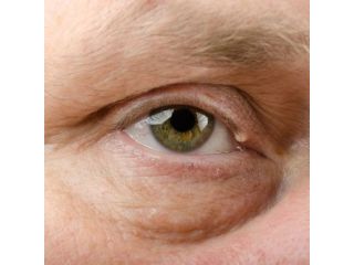 eyelid-surgery-in-los-angeles-small-0