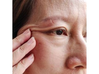 eyelid-surgery-in-los-angeles-small-1