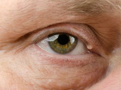 eyelid-surgery-in-los-angeles