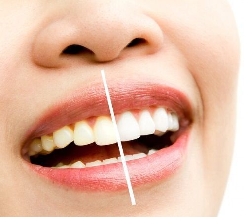 professional-teeth-whitening-pa-services-big-0