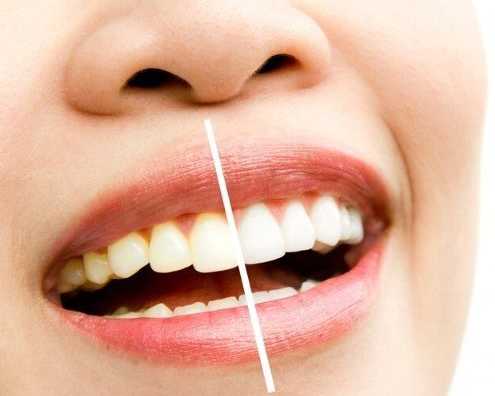 professional-teeth-whitening-pa-services