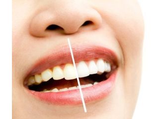 professional-teeth-whitening-pa-services-small-0