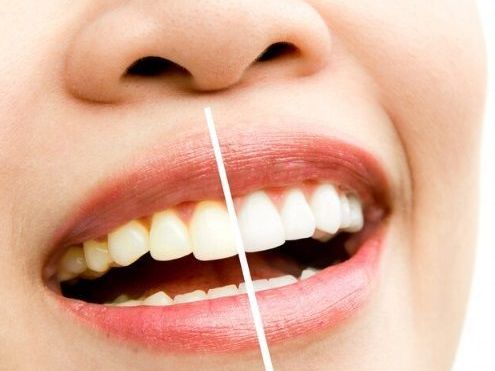 professional-teeth-whitening-pa-services