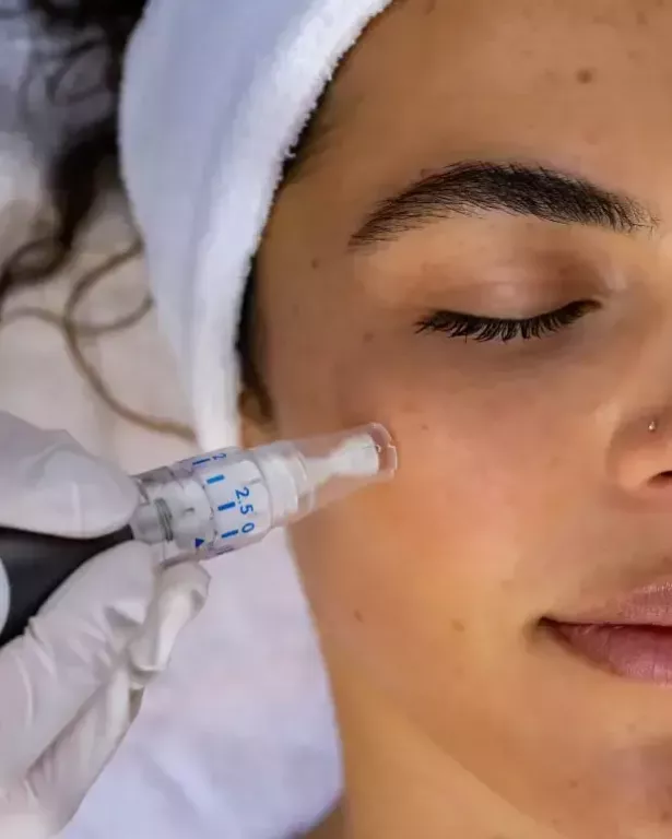 microneedling-treatment-near-me-for-healthier-skin-big-0