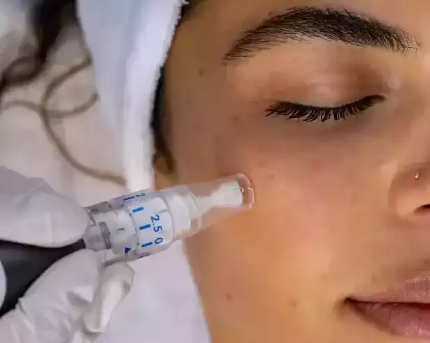 microneedling-treatment-near-me-for-healthier-skin