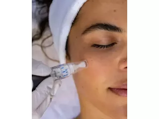 microneedling-treatment-near-me-for-healthier-skin-small-0