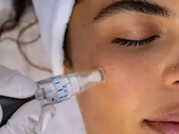 microneedling-treatment-near-me-for-healthier-skin