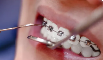 professional-dental-cleaning-near-you-call-now-big-0