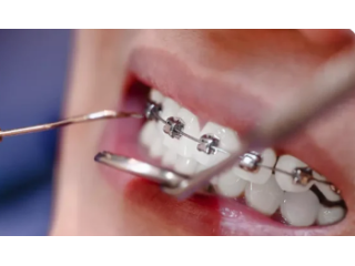 professional-dental-cleaning-near-you-call-now-small-0
