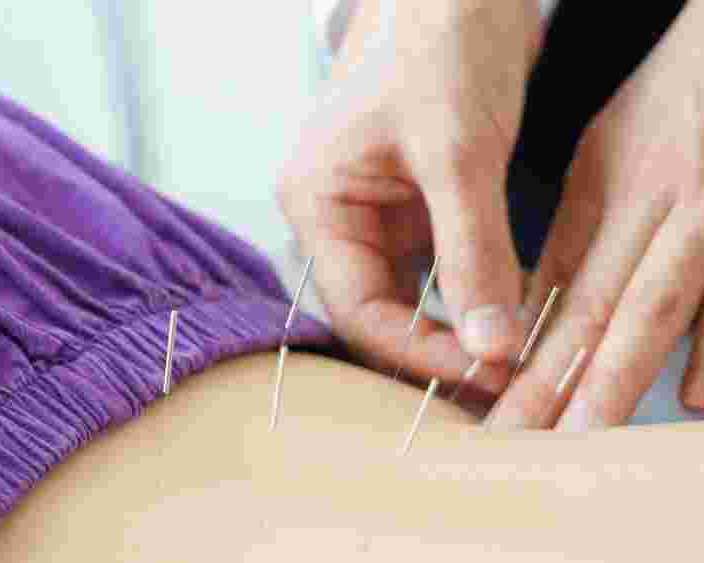 dry-needling-for-sciatica