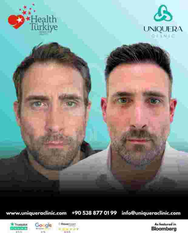 dhi-direct-hair-implantation-turkey-uniquera-clinic-istanbul-big-0