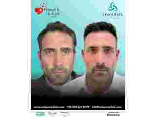 dhi-direct-hair-implantation-turkey-uniquera-clinic-istanbul-small-0