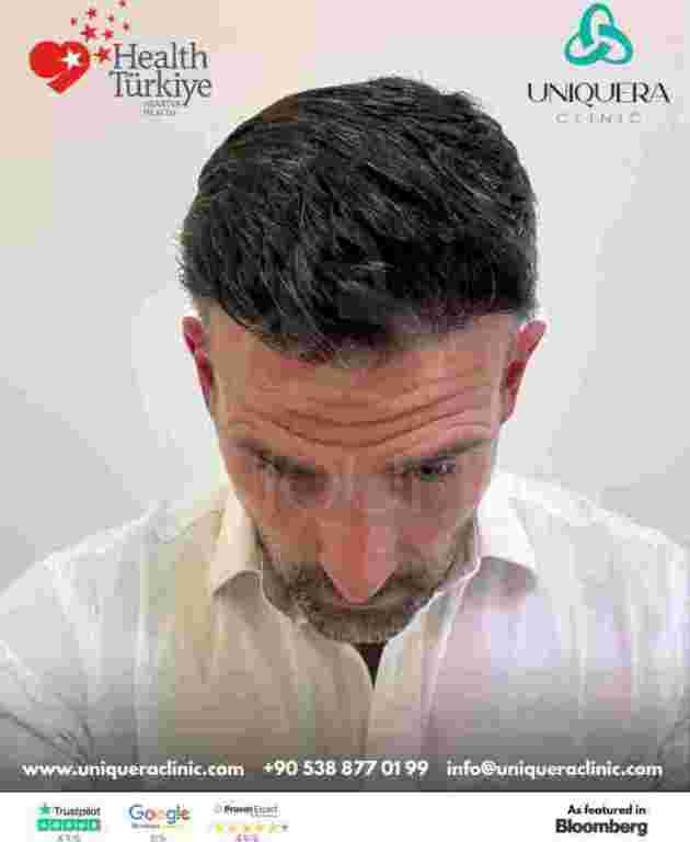 hair-transplant-surgery-turkey-uniquera-clinic-full-package-big-0