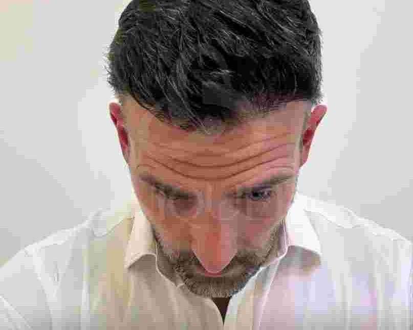 hair-transplant-surgery-turkey-uniquera-clinic-full-package