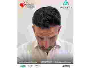 hair-transplant-surgery-turkey-uniquera-clinic-full-package-small-0