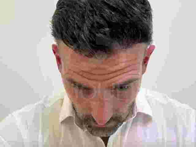 hair-transplant-surgery-turkey-uniquera-clinic-full-package
