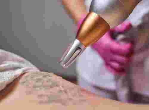 glycolic-acid-tattoo-removal-big-0