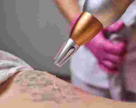 glycolic-acid-tattoo-removal