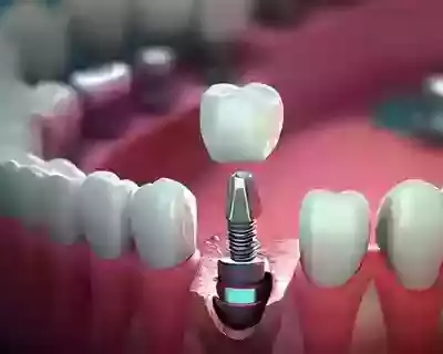 single-dental-implant-for-a-strong-natural-looking-smile