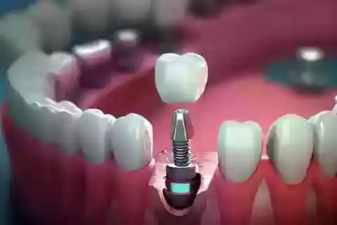 single-dental-implant-for-a-strong-natural-looking-smile-big-0
