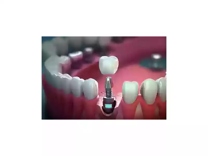 single-dental-implant-for-a-strong-natural-looking-smile-small-0