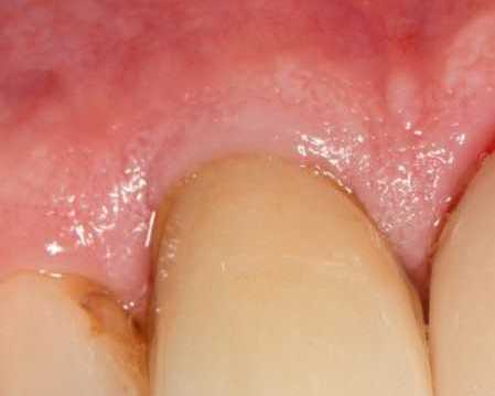 fast-tooth-replacement-with-modern-implant-technology