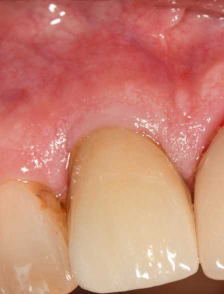 fast-tooth-replacement-with-modern-implant-technology-big-0