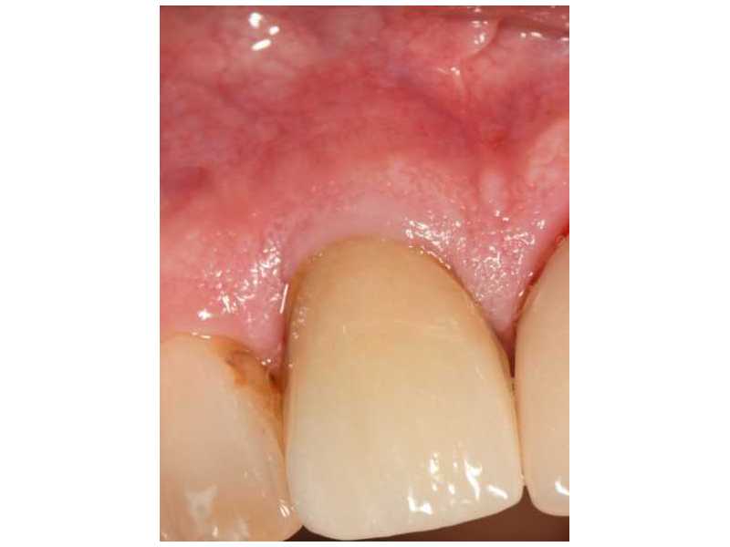 fast-tooth-replacement-with-modern-implant-technology-small-0