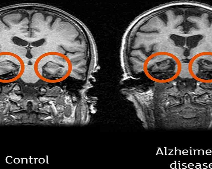 alzheimer-research-breakthroughs-with-neuroem-study-insights