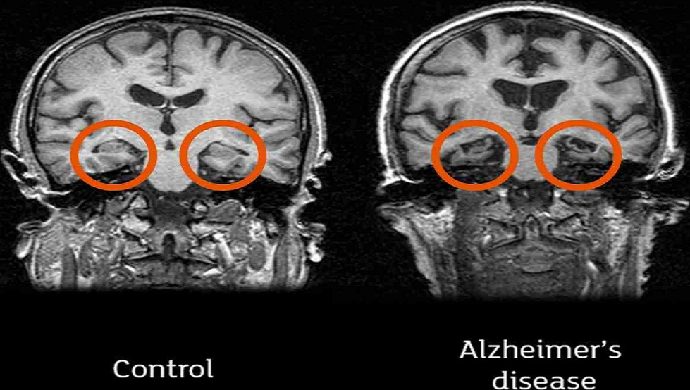 alzheimer-research-breakthroughs-with-neuroem-study-insights-big-0