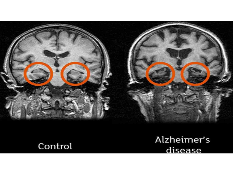 alzheimer-research-breakthroughs-with-neuroem-study-insights-small-0