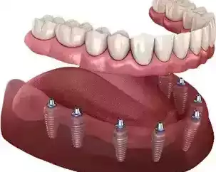 affordable-dental-implants-wilmington-quality-care