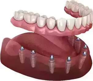 affordable-dental-implants-wilmington-quality-care-big-0