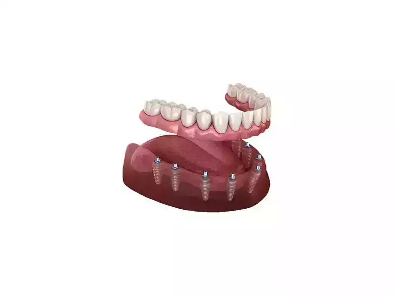 affordable-dental-implants-wilmington-quality-care-small-0