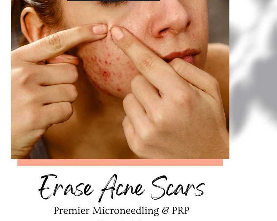erase-acne-scars-premier-microneedling-prp-at