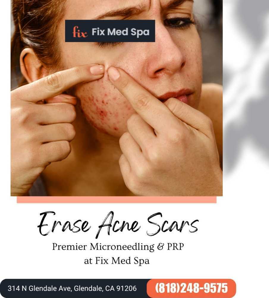 erase-acne-scars-premier-microneedling-prp-at-big-0