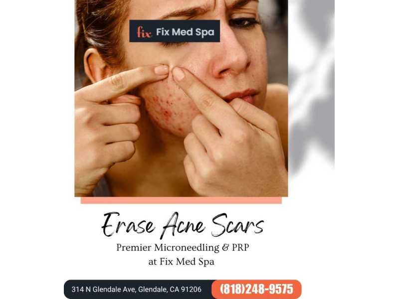 erase-acne-scars-premier-microneedling-prp-at-small-0