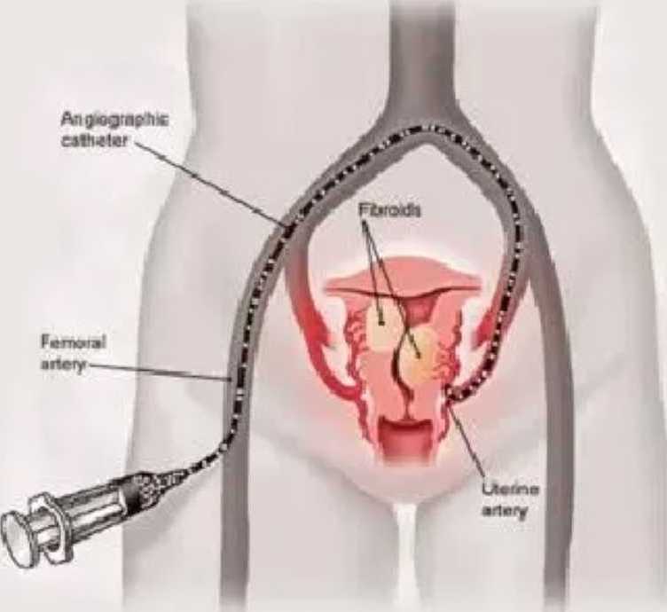 ufe-vs-myomectomy-which-fibroid-treatment-option-is-right-for-you-big-0