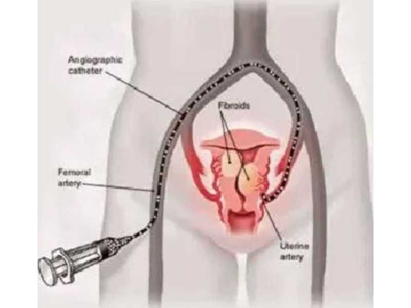 ufe-vs-myomectomy-which-fibroid-treatment-option-is-right-for-you-small-0