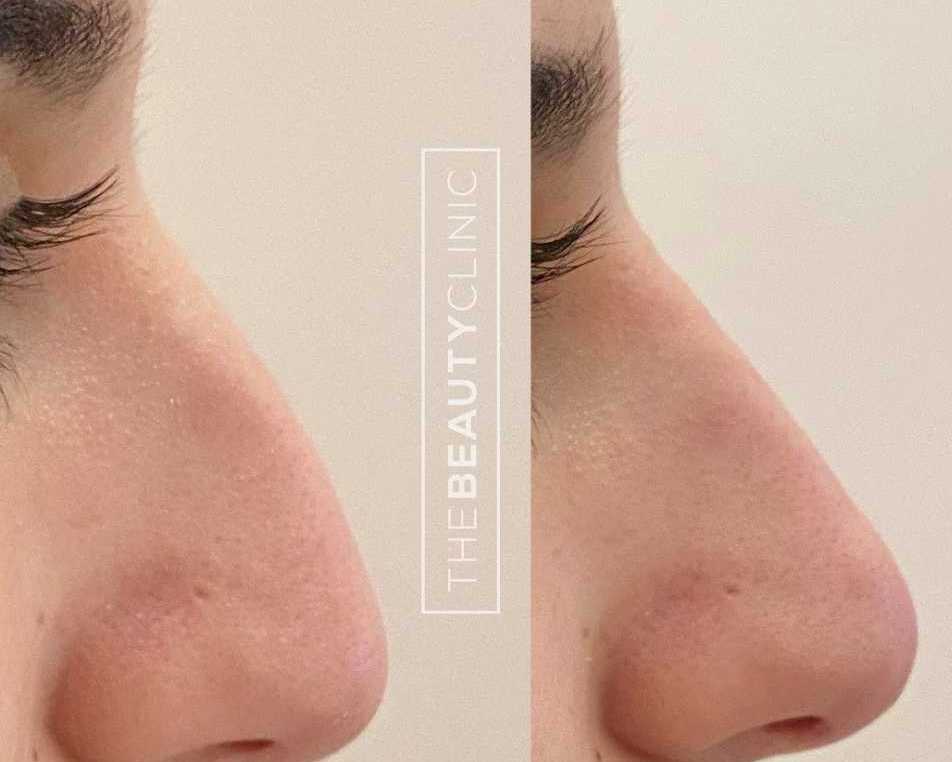 liquid-rhinoplasty-miami-non-surgical-nose-reshaping-with-filler