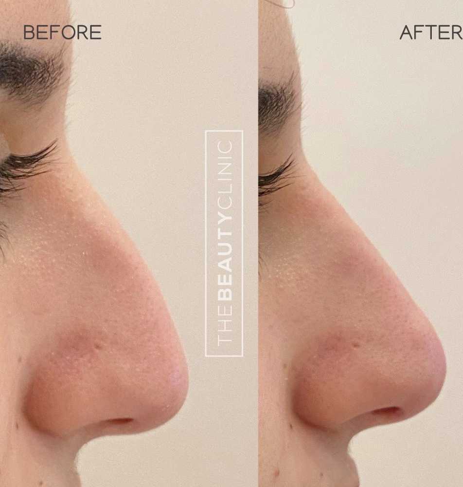 liquid-rhinoplasty-miami-non-surgical-nose-reshaping-with-filler-big-0